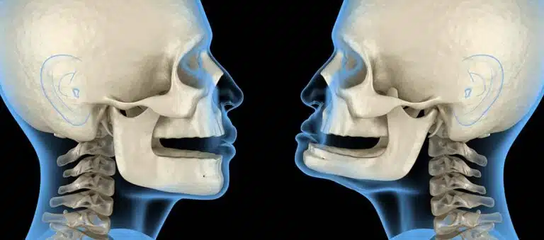 Jaw Alignment