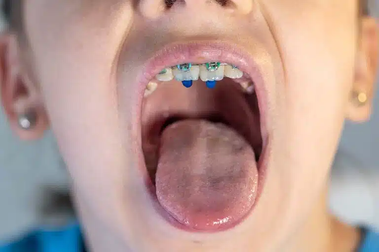 Teeth Cleaning in Children