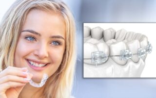 Invisalign vs Clear Braces