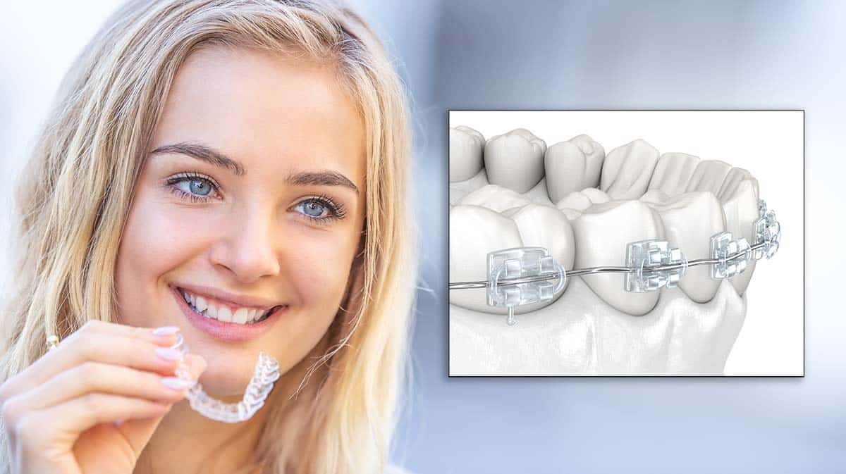 Invisalign vs Clear Braces