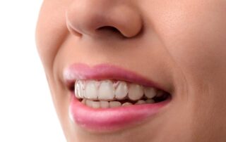 Blog Invisalign treatment in Richmond Texas