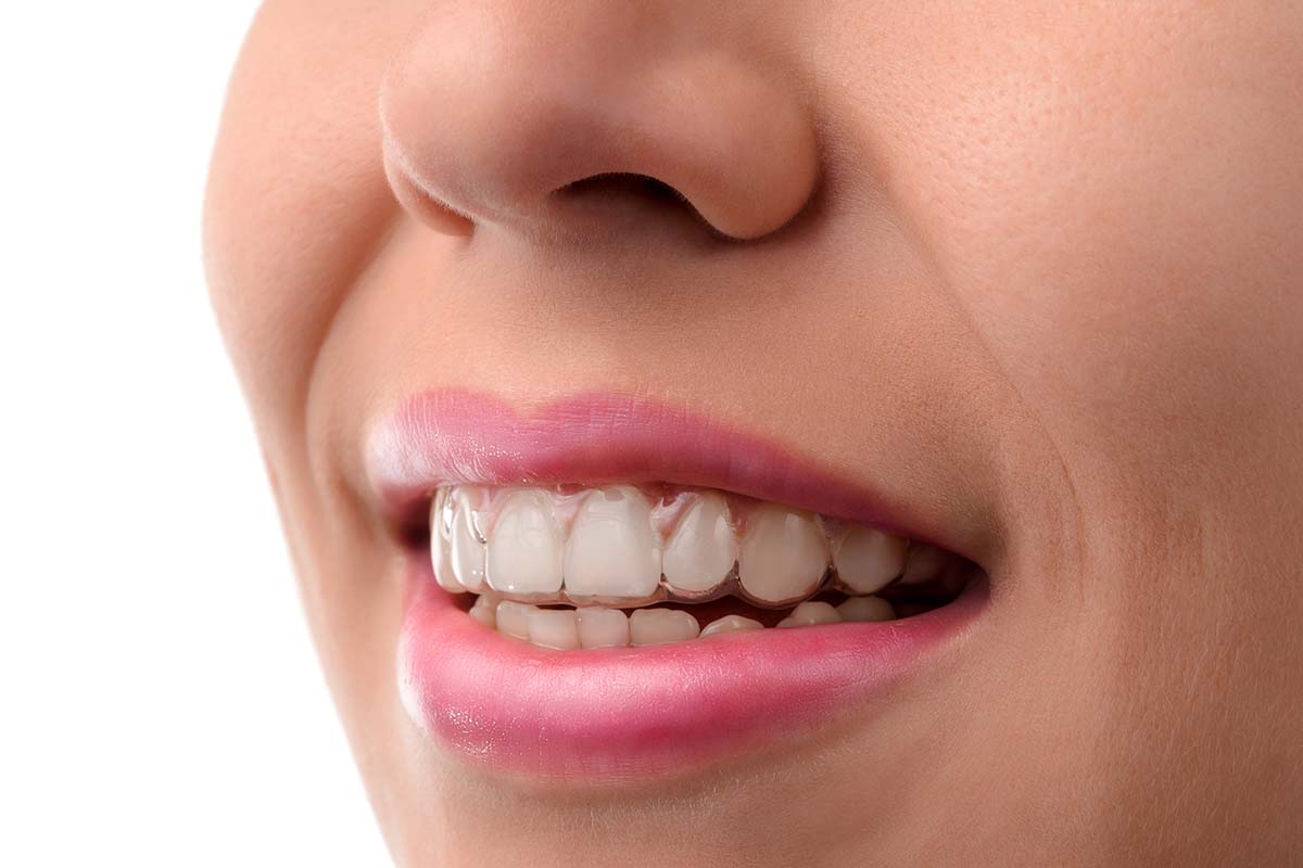 Invisalign treatment for Houston, TX