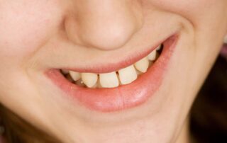 gaps in teeth treatment