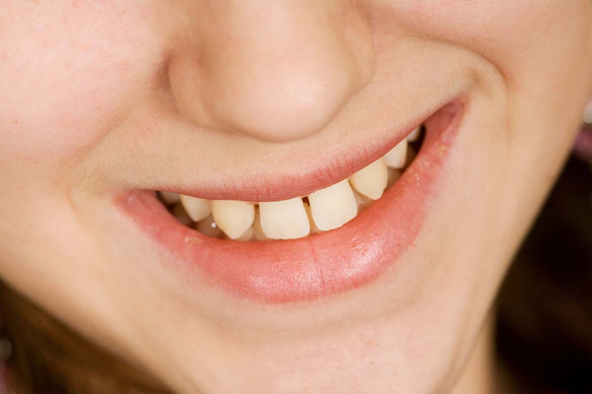 gaps in teeth treatment