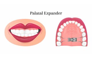 Rapid Palatal Expander?