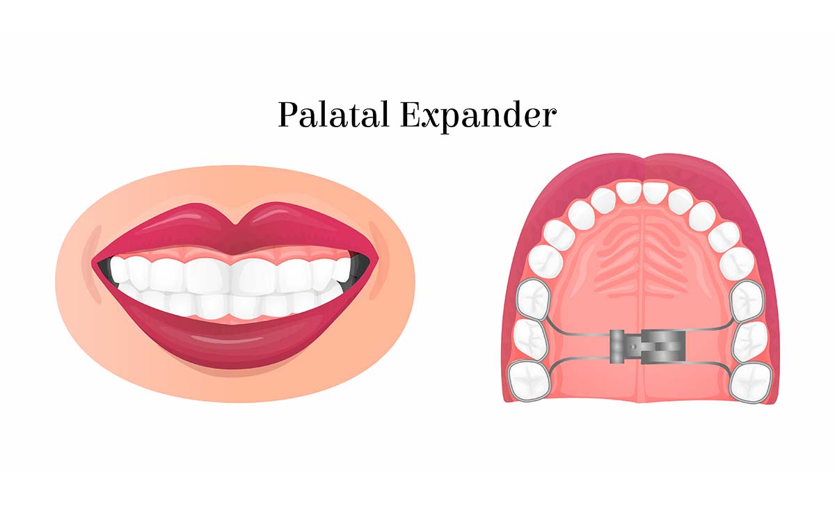 Rapid Palatal Expander