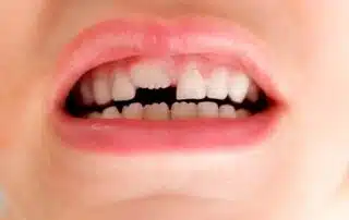 Tooth Mamelons