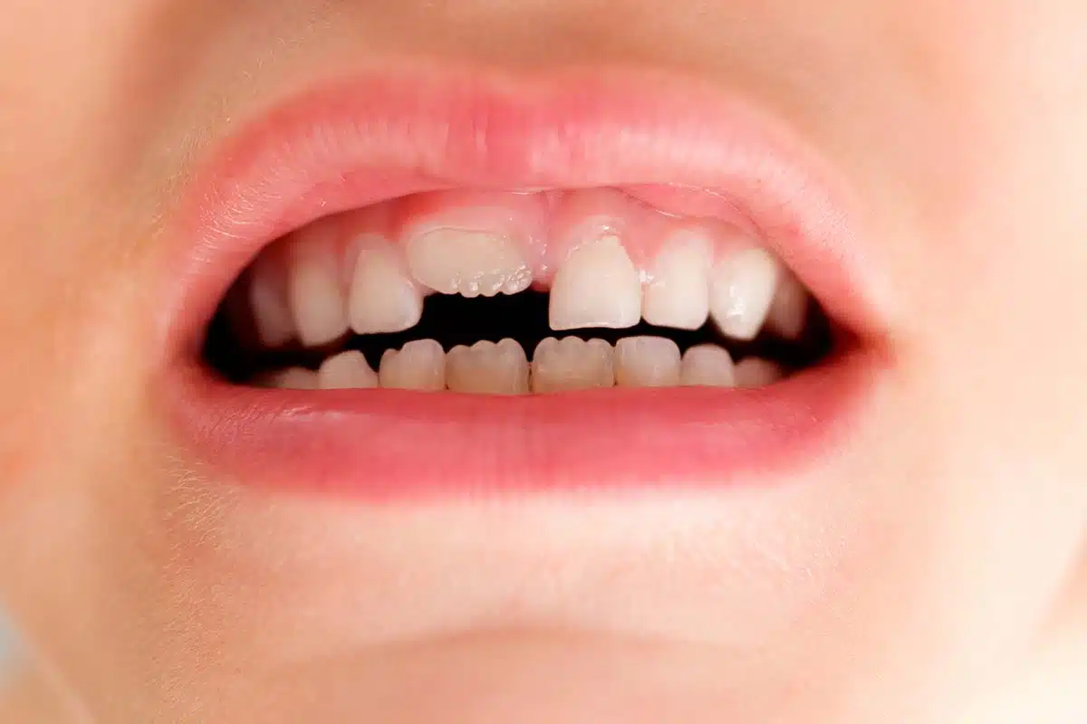 Tooth Mamelons