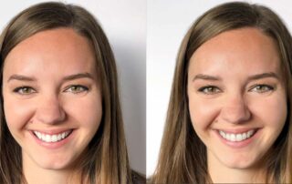 adult Invisalign before and after