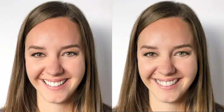 adult Invisalign before and after