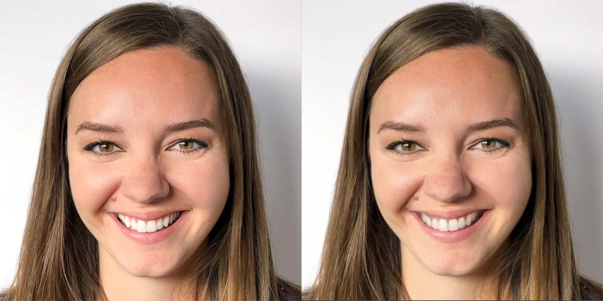 adult Invisalign before and after