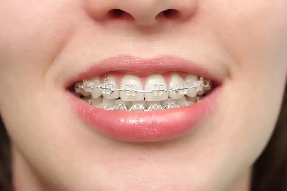 braces-closeup