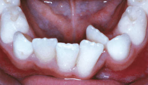 Crossbite of the front teeth