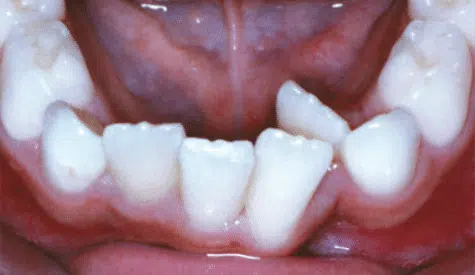 Crowding Crossbite of the front teeth
