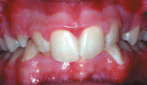 Crossbite of the front teeth