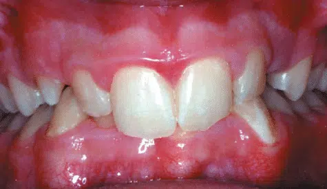 Deep-bite Crossbite of the front teeth