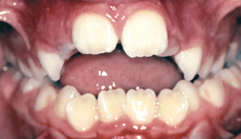 Crossbite of the front teeth