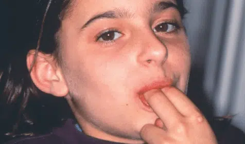 Oral-habits Happy Girl with Braces