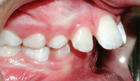 Crossbite of the front teeth