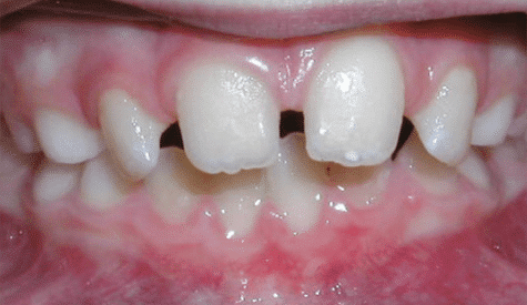 Crossbite of the front teeth