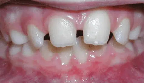 Spacing Crossbite of the front teeth