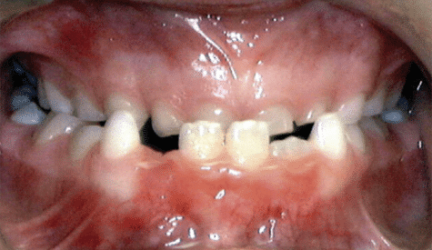 Crossbite of the front teeth