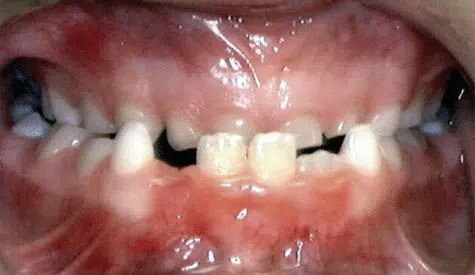Underbite Crossbite of the front teeth