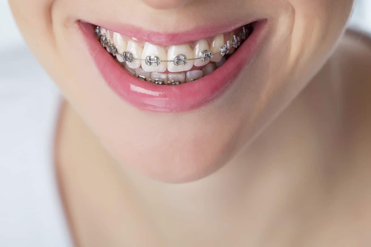 metal braces