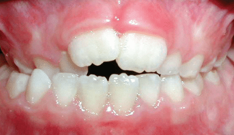 Crossbite of the front teeth