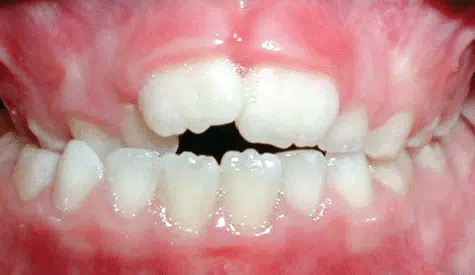 X-bite-Post Crossbite of the front teeth
