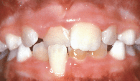 Crossbite of the front teeth