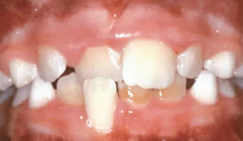 X-bite Crossbite of the front teeth