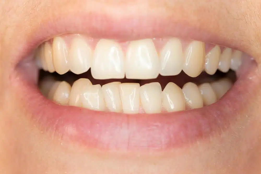crowding-teeth
