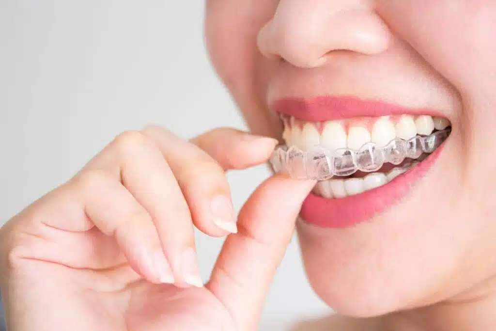 A person at Elara Orthodontics in Richmond or Houston, TX, smiles while putting on an Invisalign clear aligner - How to Choose an Orthodontist & When to See an Orthodontist