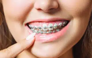 A person smiles and proudly points to their metal braces at Elara Orthodontics in Richmond or Houston, TX.