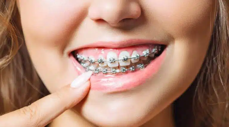 A person smiles and proudly points to their metal braces at Elara Orthodontics in Richmond or Houston, TX.