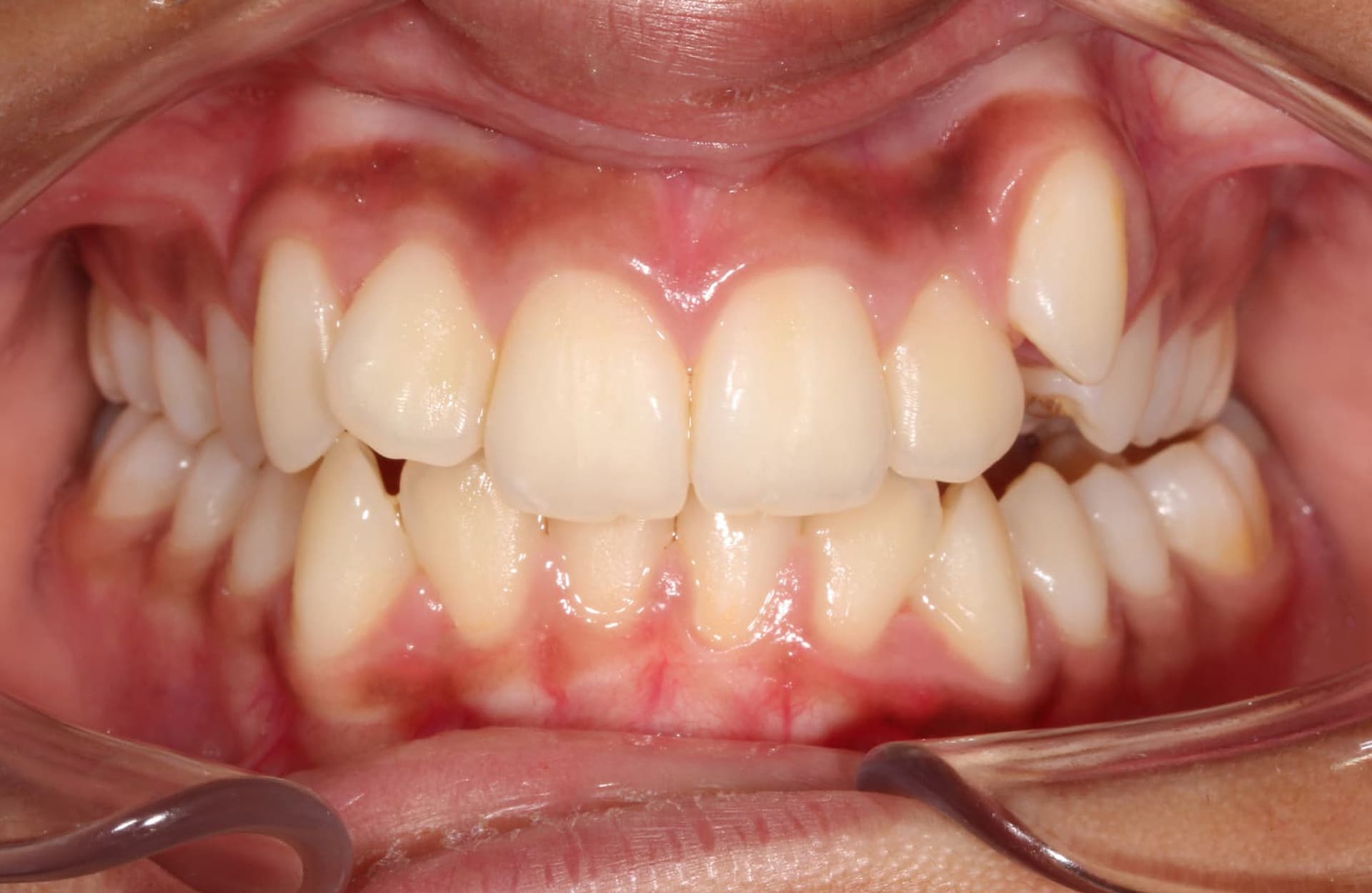 A crossbite before treatment at Elara Orthodontics in Houston, TX, with retractors exposing teeth and gums.