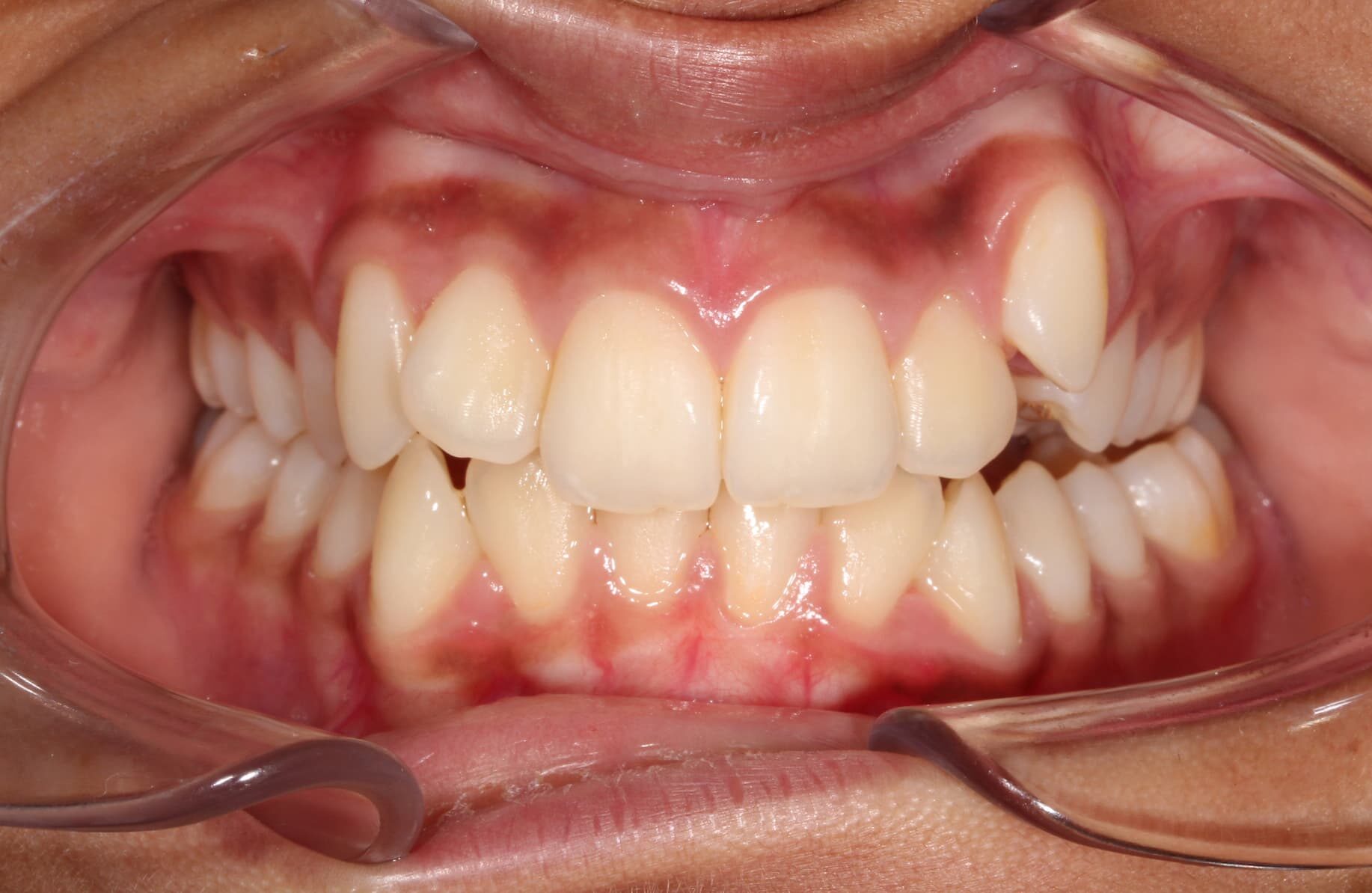 A displays before braces treatment at Elara Orthodontics in Houston, TX.