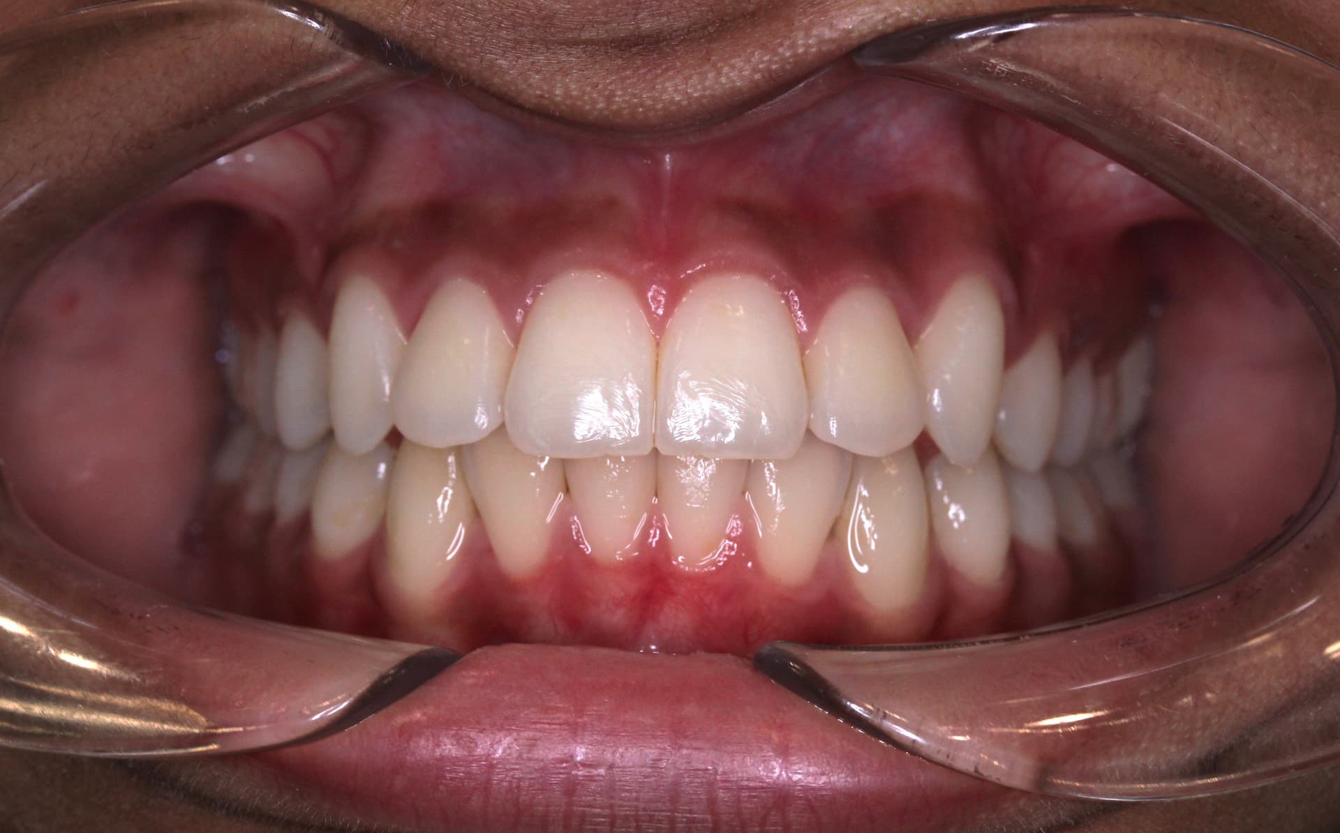 A displays after braces treatment at Elara Orthodontics in Houston, TX.