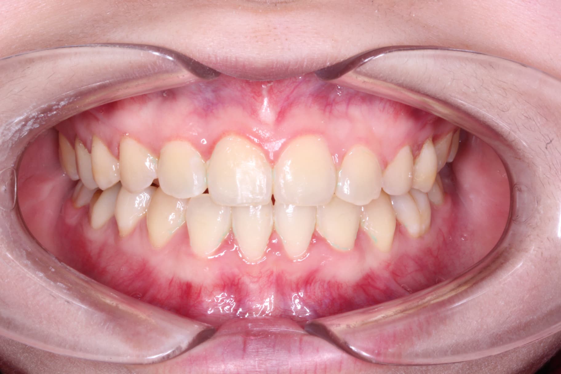 A displays after braces treatment at Elara Orthodontics in Houston, TX.