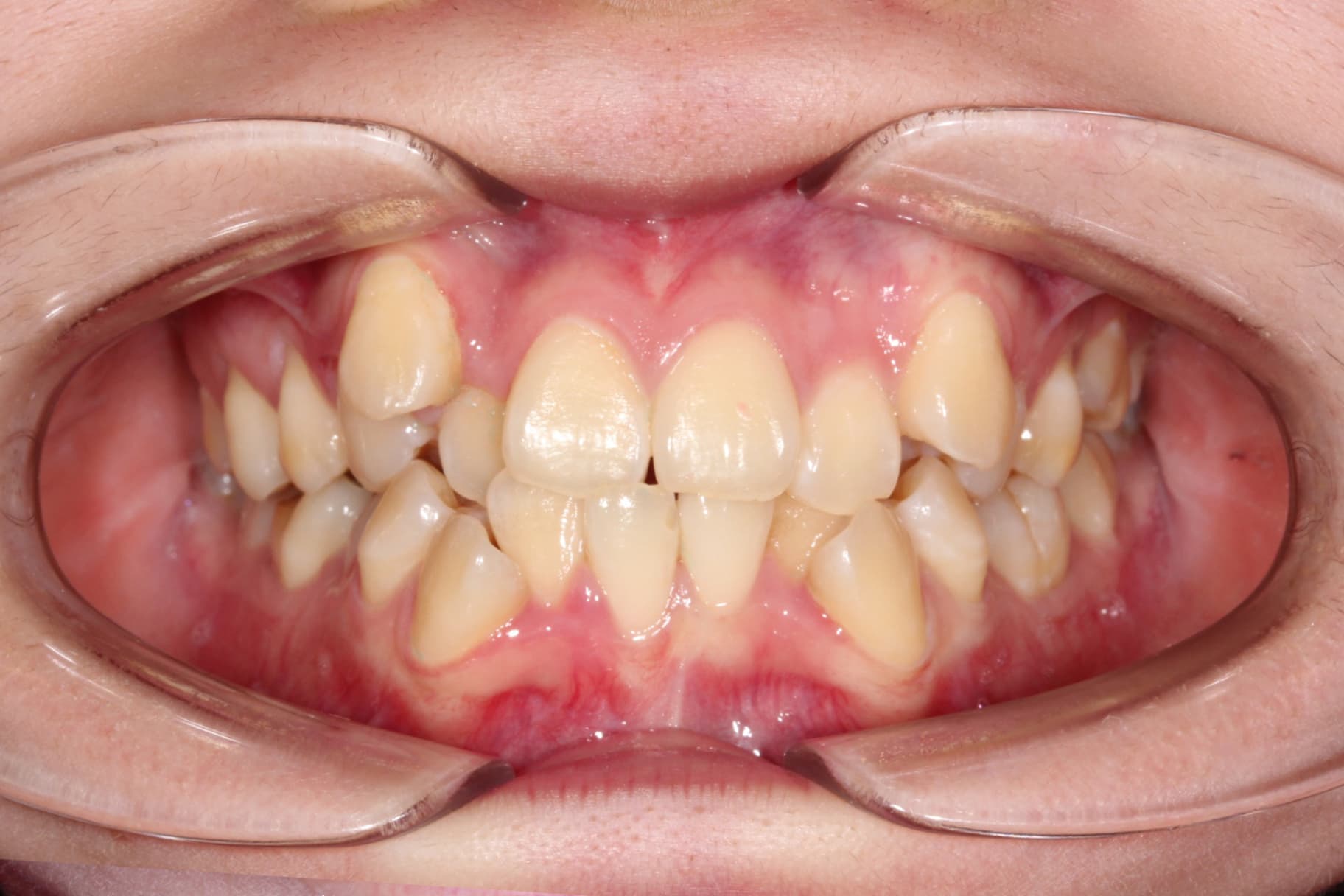 A displays before braces treatment at Elara Orthodontics in Houston, TX.