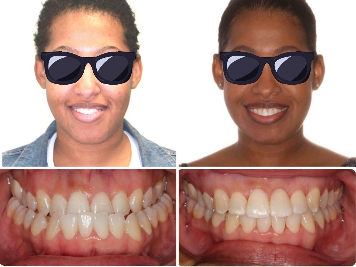 Before and after images of a woman’s smile treated at Elara Orthodontics in Richmond, TX; eyes concealed by sunglasses.