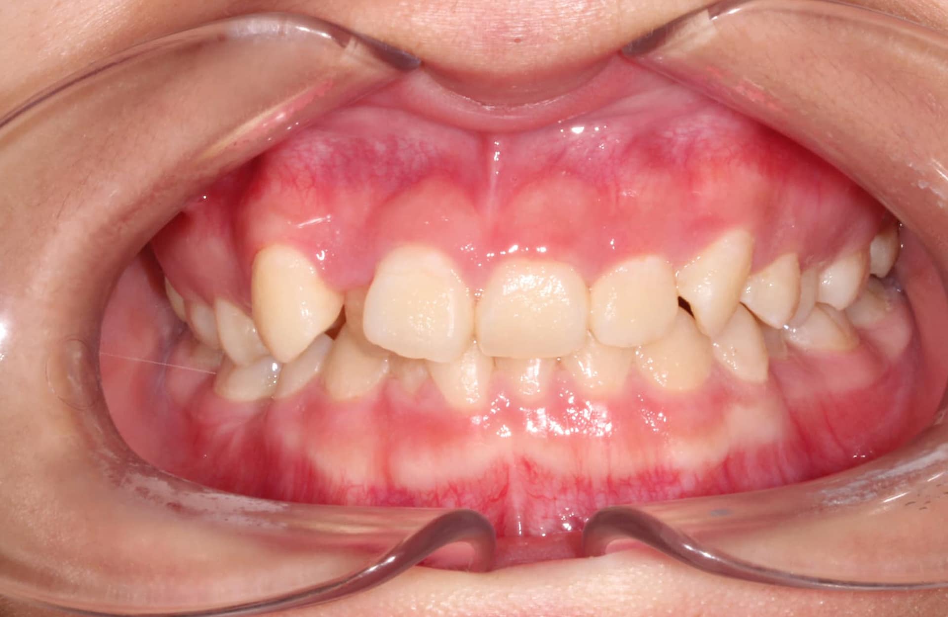 Severe teeth crowding and misalignment are visible during an exam at Elara Orthodontics in Houston, TX.