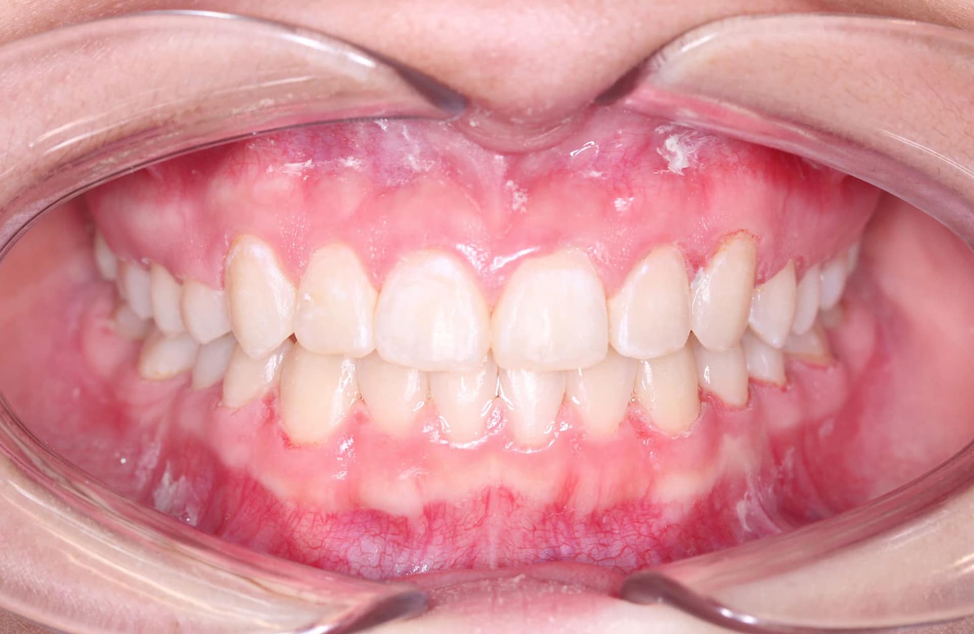 Teeth and gums with redness and crowding after orthodontic treatment at Elara Orthodontics in Houston, TX.