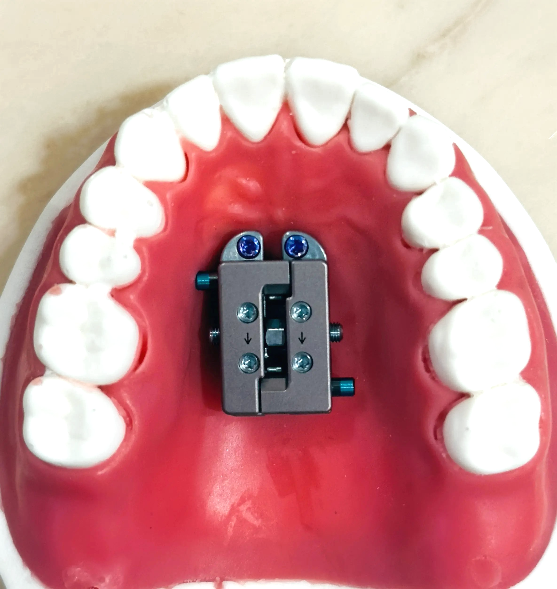 A dental model with a FME appliance on upper teeth, as offered by Elara Orthodontics in Richmond or Houston, TX.