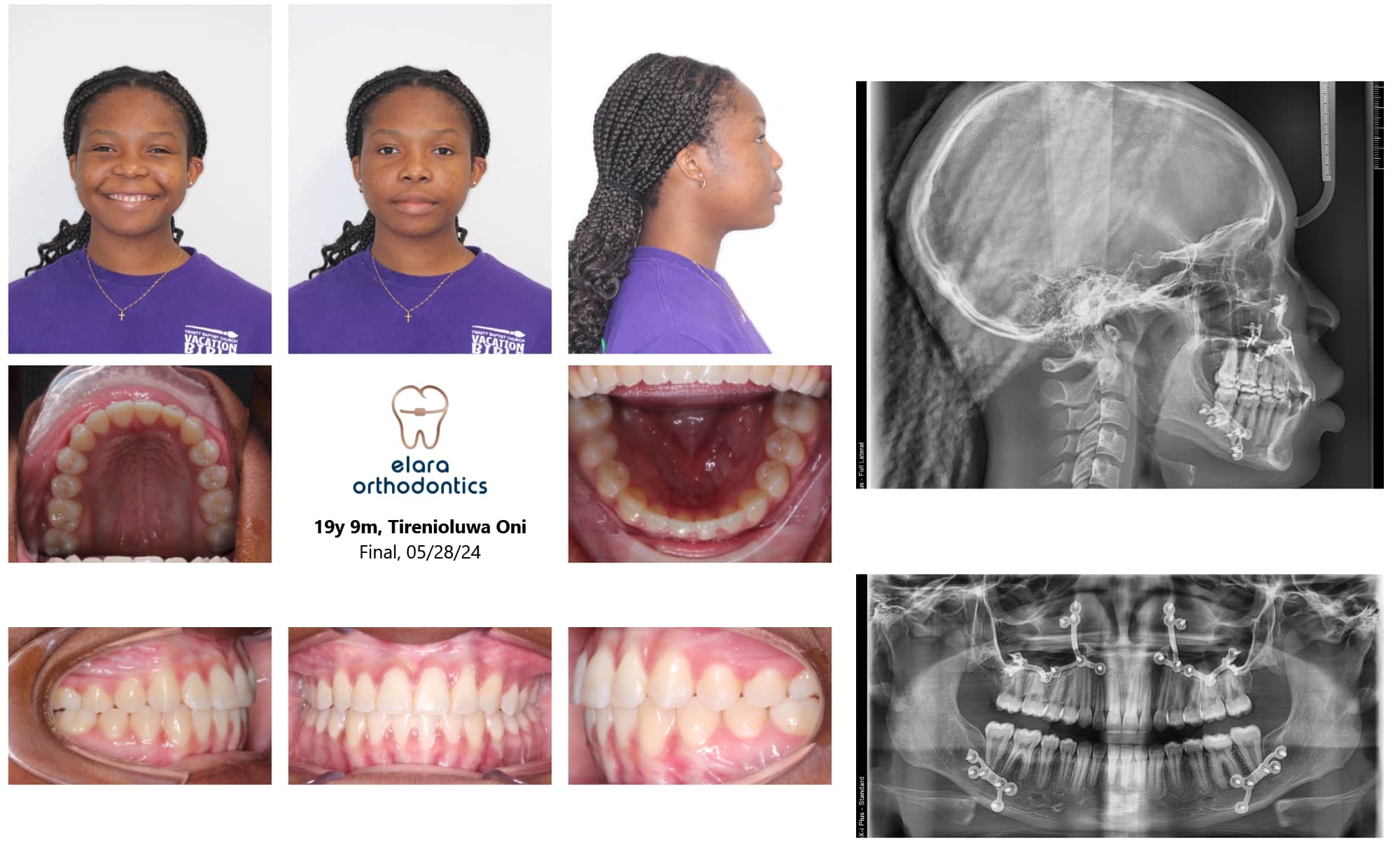 Before and after braces photos, portraits, X-rays, and bite alignment for a 19-year-old female at Elara Orthodontics in Houston, TX.