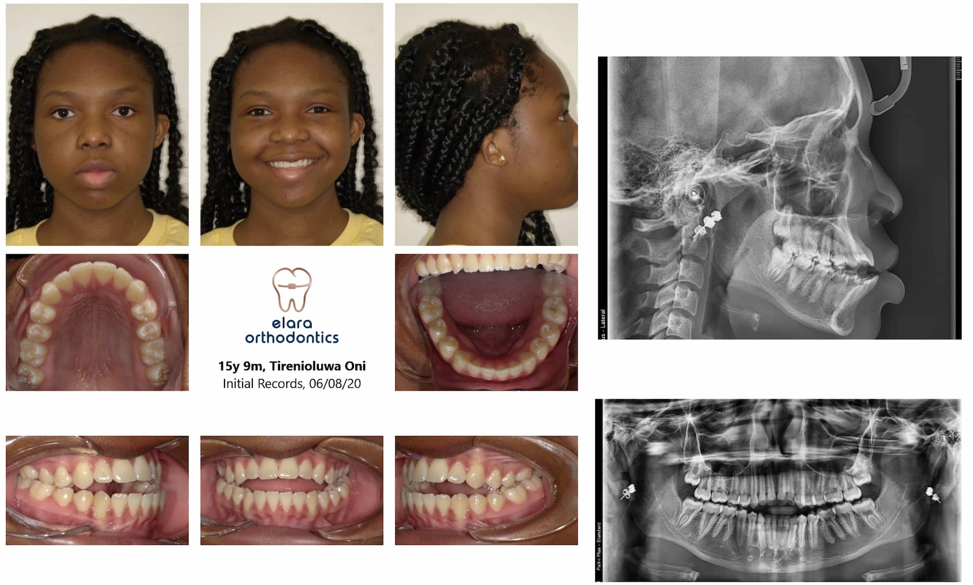 Orthodontic records at Elara Orthodontics in Houston, TX: before/after photos, profile shots, X-rays, and patient info.