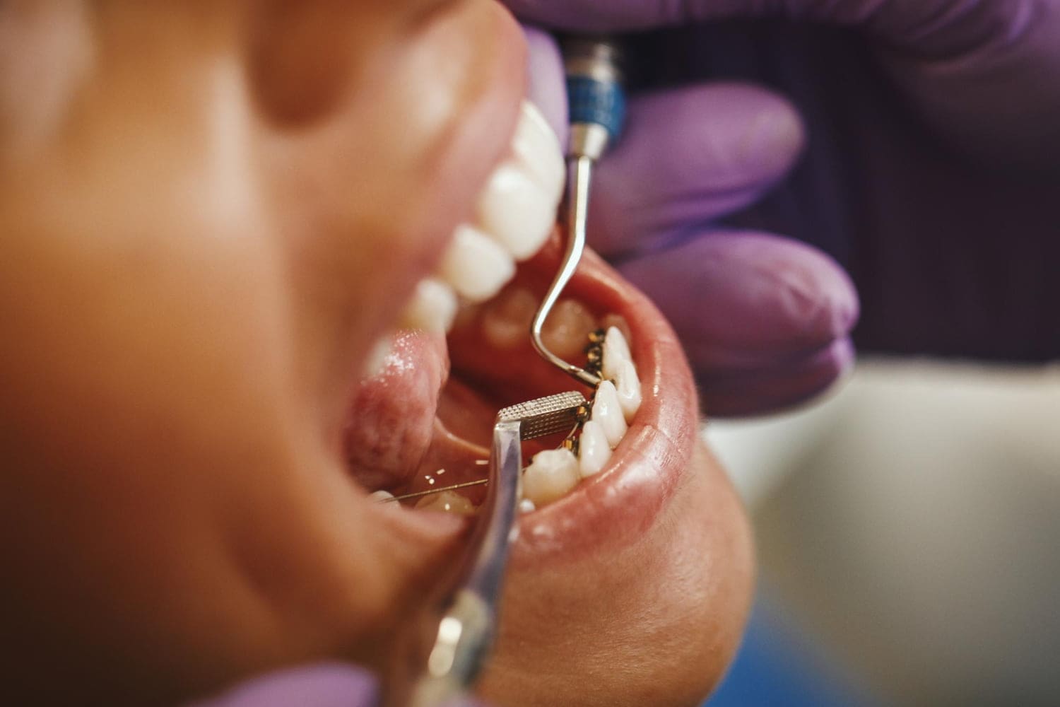 A dental professional at Elara Orthodontics in Houston, TX cleans and examines lingual braces in a patient’s open mouth.
