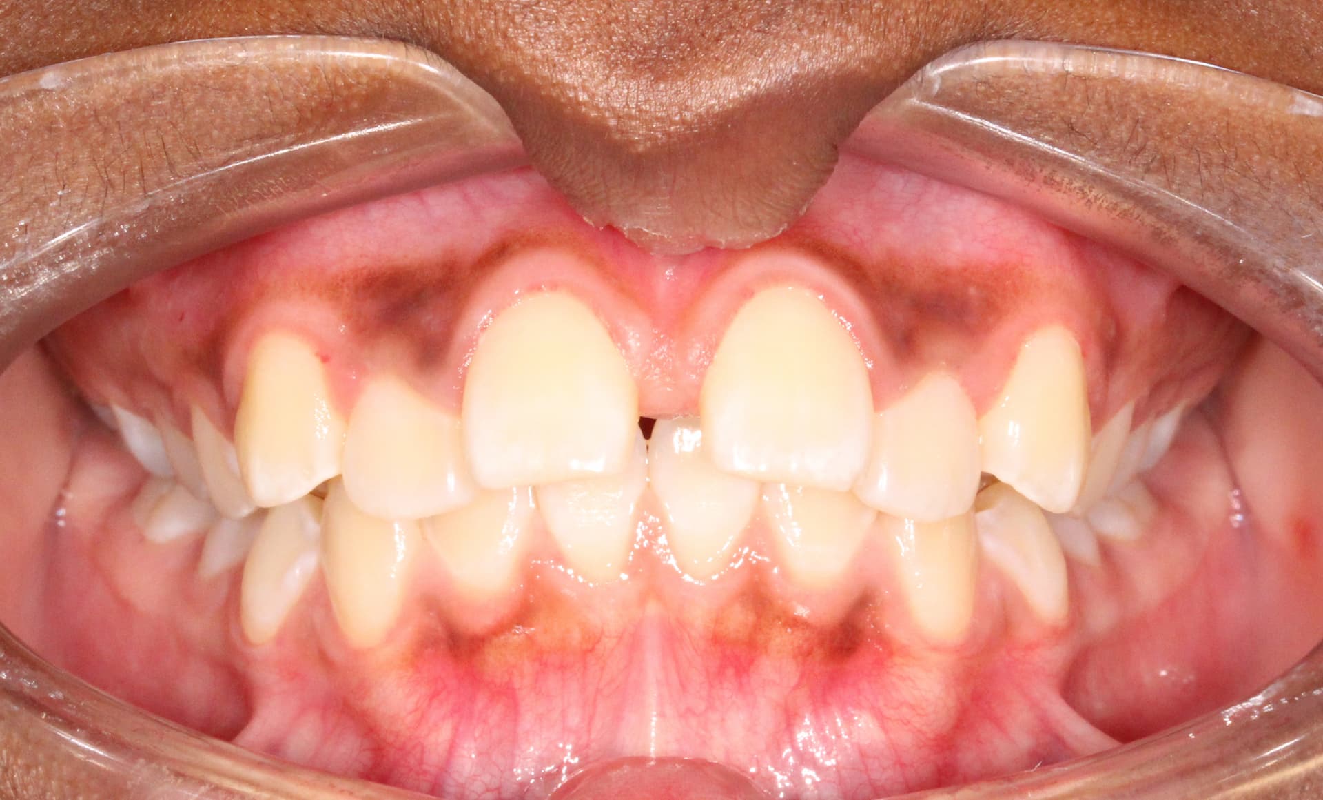 A close-up at Elara Orthodontics in Richmond, TX shows open mouth, severe overjet, gum pigmentation, and retractors.