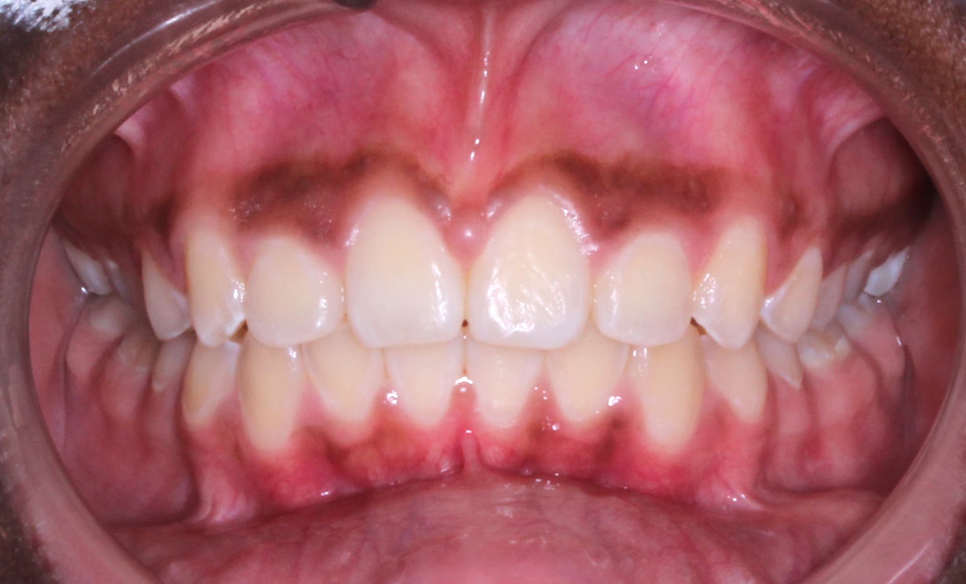 Open mouth close-up showing teeth, gums, and pigmentation after overjet correction at Elara Orthodontics in Richmond, TX.